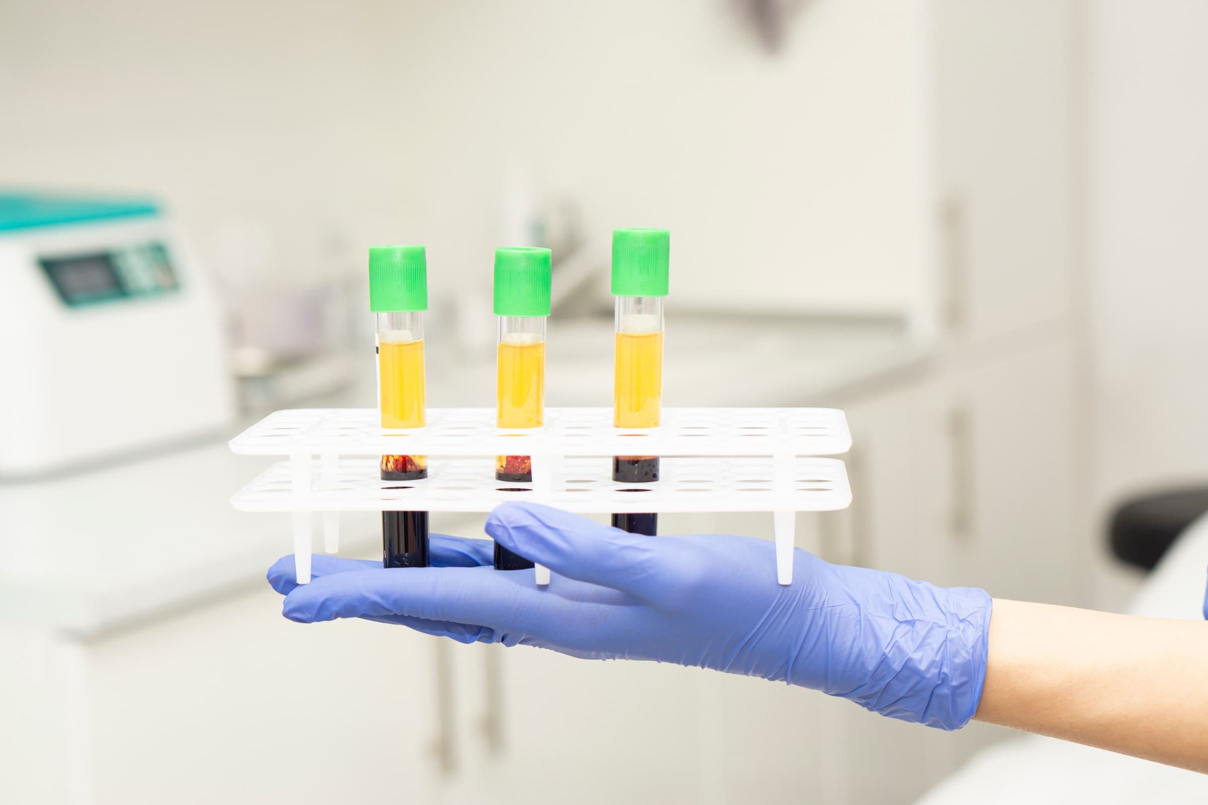 Prepared platelet-rich plasma vials in a clinic